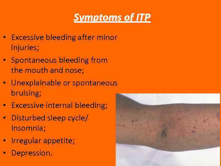  Symptoms of ITP • Excessive bleeding after minor injuries; • Spontaneous bleeding from