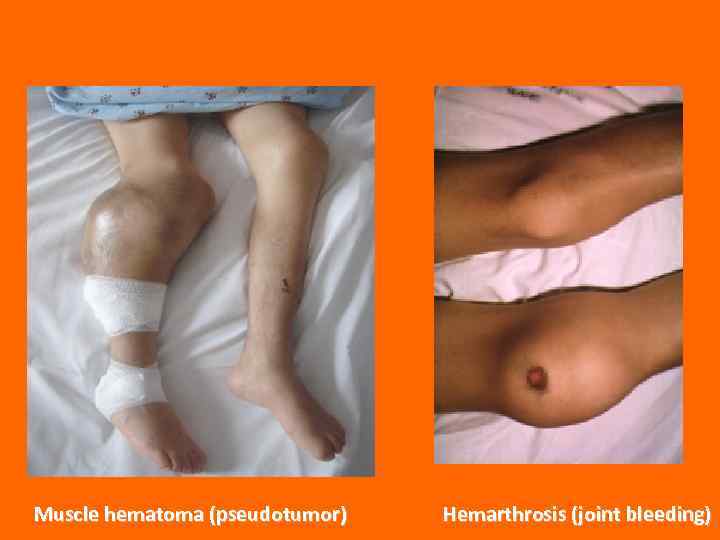 Muscle hematoma (pseudotumor) Hemarthrosis (joint bleeding) 