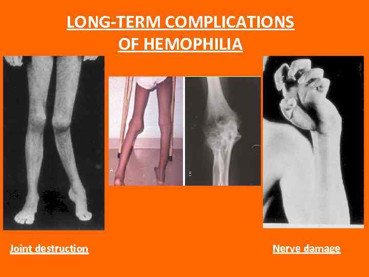 LONG-TERM COMPLICATIONS OF HEMOPHILIA Joint destruction Nerve damage 