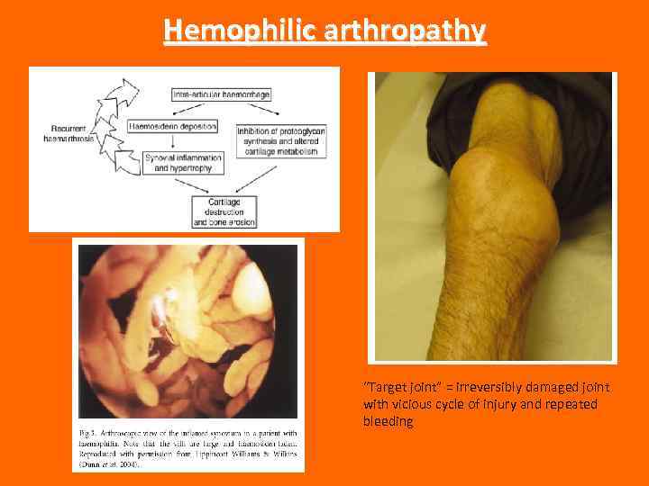 Hemophilic arthropathy “Target joint” = irreversibly damaged joint with vicious cycle of injury and