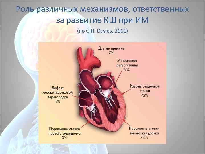 Роль различных механизмов, ответственных за развитие КШ при ИМ (по C. H. Davies, 2001)