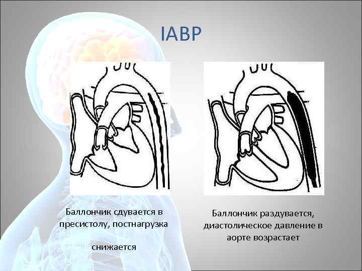 IABP Баллончик сдувается в пресистолу, постнагрузка снижается Баллончик раздувается, диастолическое давление в аорте возрастает