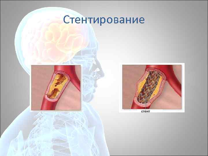 Стентирование 
