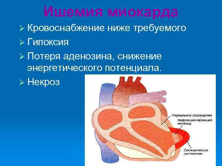 Ишемия миокарда Ø Кровоснабжение ниже требуемого Ø Гипоксия Ø Потеря аденозина, снижение энергетического потенциала.