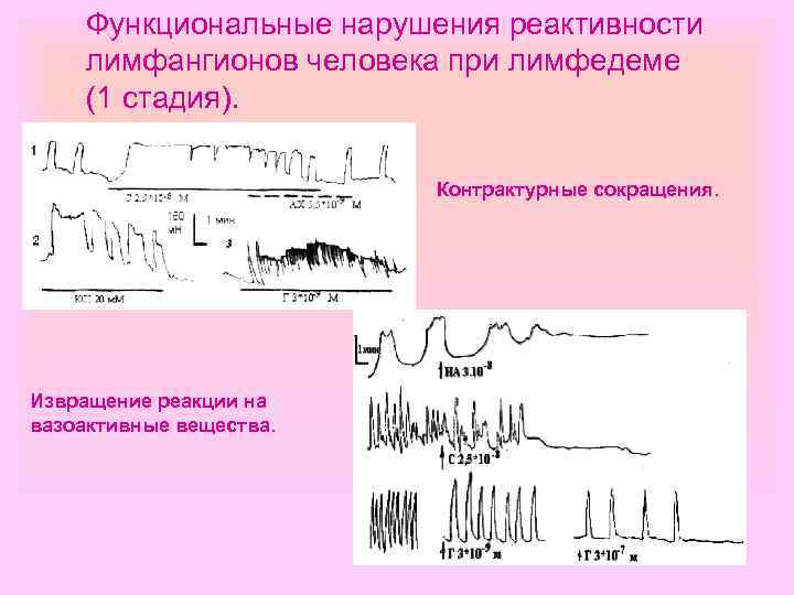 Функциональные нарушения реактивности лимфангионов человека при лимфедеме (1 стадия). Контрактурные сокращения. Извращение реакции на