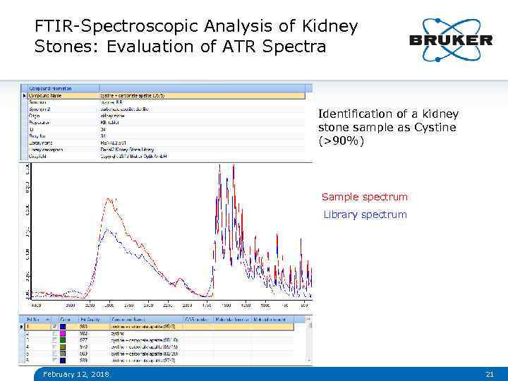 FTIR-Spectroscopic Analysis of Kidney Stones: Evaluation of ATR Spectra Identification of a kidney stone