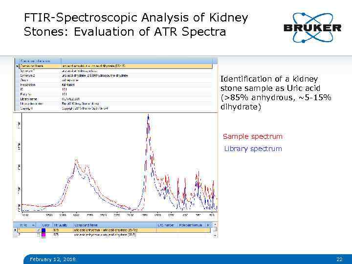 FTIR-Spectroscopic Analysis of Kidney Stones: Evaluation of ATR Spectra Identification of a kidney stone
