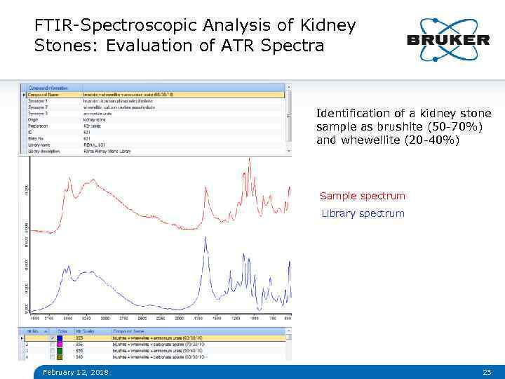 FTIR-Spectroscopic Analysis of Kidney Stones: Evaluation of ATR Spectra Identification of a kidney stone
