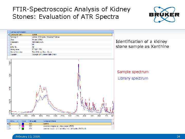 FTIR-Spectroscopic Analysis of Kidney Stones: Evaluation of ATR Spectra Identification of a kidney stone
