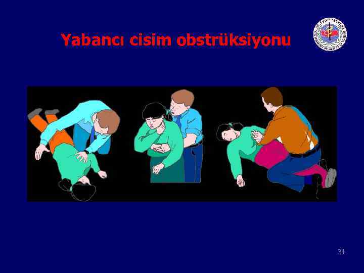 Yabancı cisim obstrüksiyonu 31 