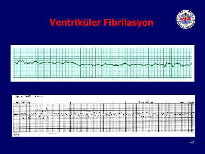 Ventriküler Fibrilasyon 46 