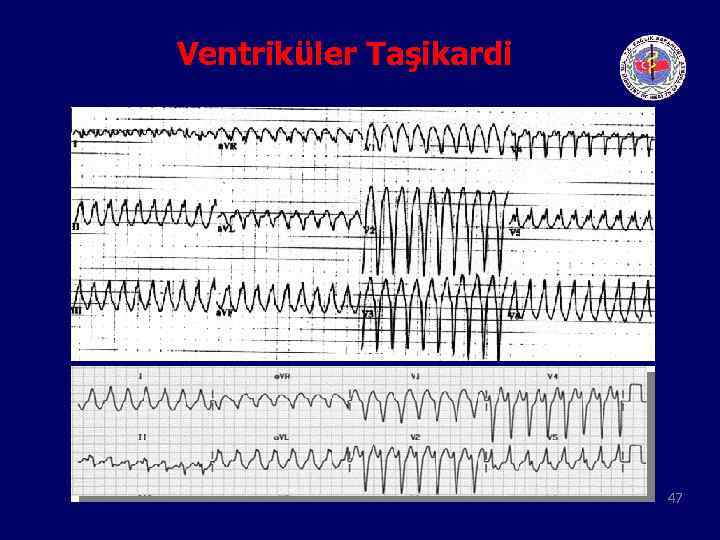 Ventriküler Taşikardi 47 