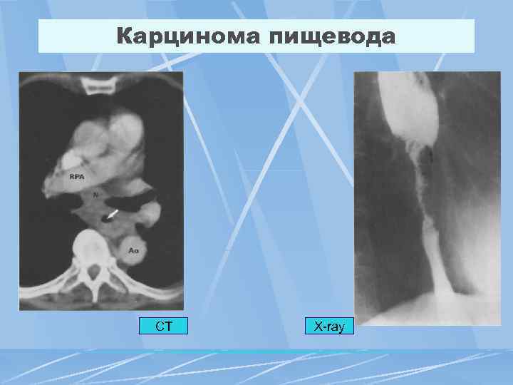 Карцинома пищевода CT X-ray 