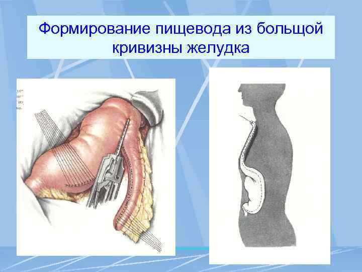 Формирование пищевода из больщой кривизны желудка 
