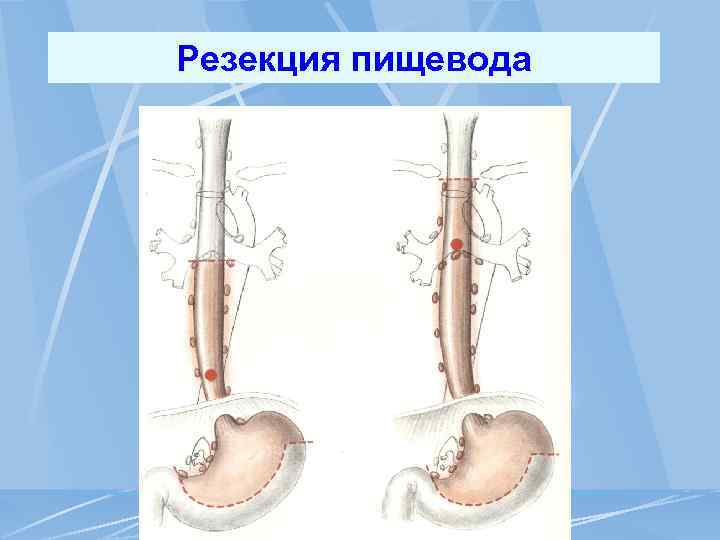Резекция пищевода 