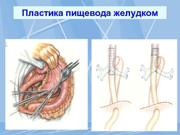 Пластика пищевода желудком 