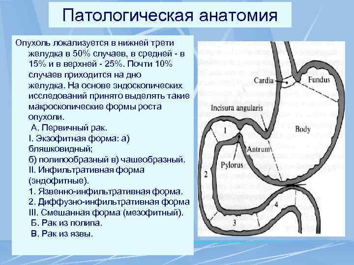 Патологическая анатомия Опухоль локализуется в нижней трети желудка в 50% случаев, в средней -