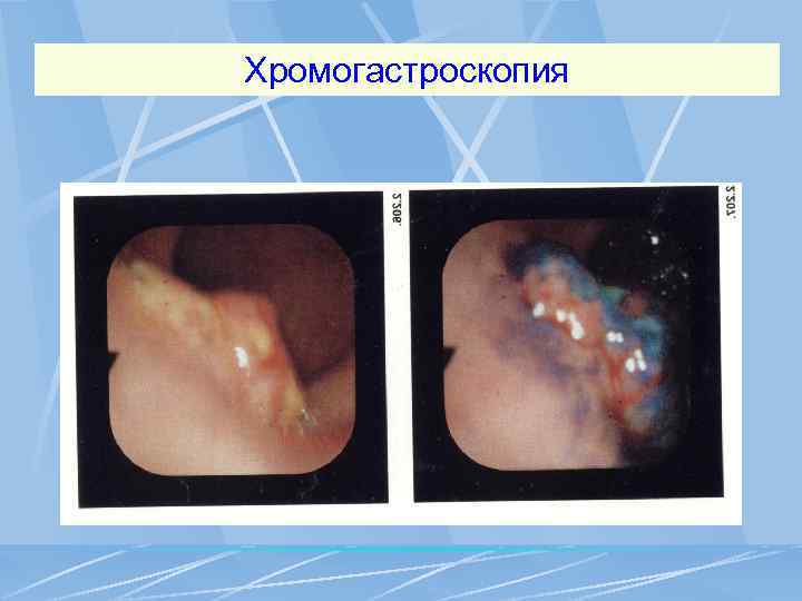 Хромогастроскопия 