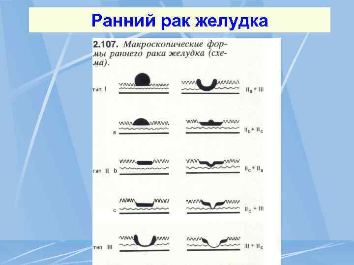Ранний рак желудка 