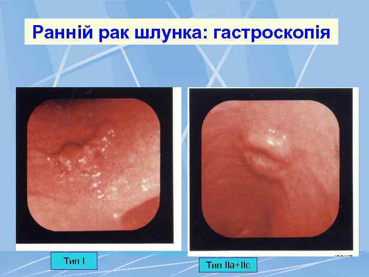 Ранній рак шлунка: гастроскопія Тип ІІа+ІІс 
