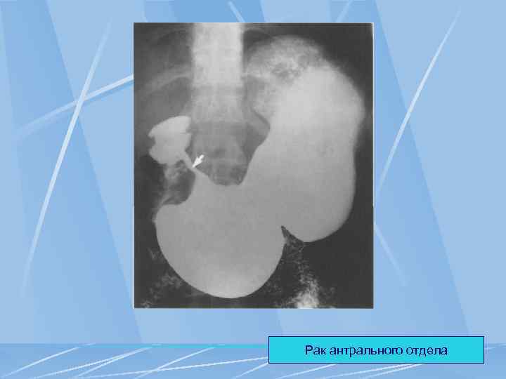 Рак антрального отдела 