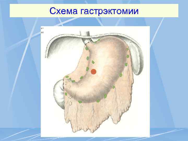 Схема гастрэктомии 