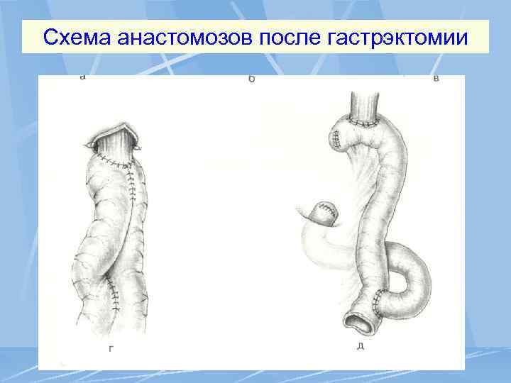 Схема анастомозов после гастрэктомии 