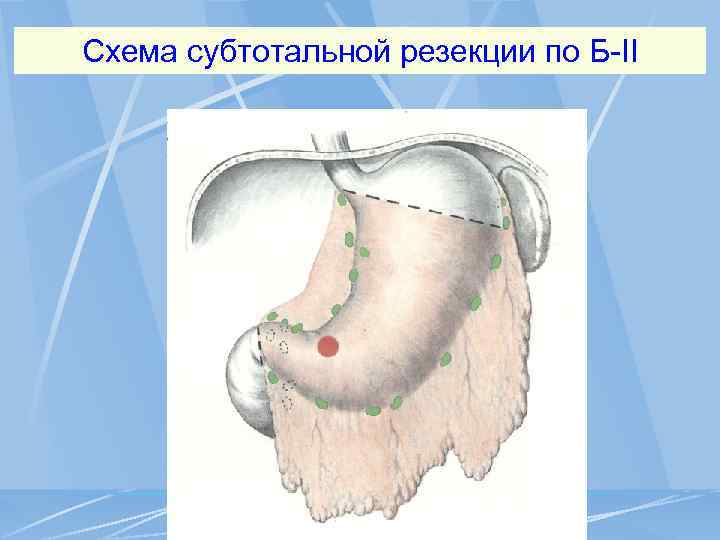 Схема субтотальной резекции по Б-II 