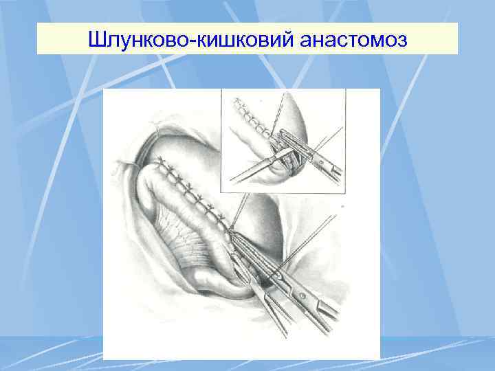 Шлунково-кишковий анастомоз 