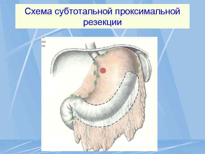 Схема субтотальной проксимальной резекции 