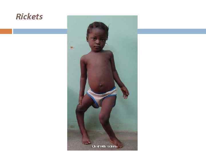 Rickets 