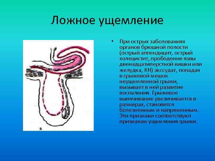 Ложное ущемление • При острых заболеваниях органов брюшной полости (острый аппендицит, острый холецистит, прободение