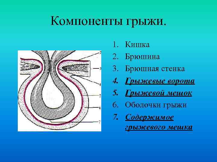 Компоненты грыжи. 1. 2. 3. 4. 5. 6. 7. Кишка Брюшина Брюшная стенка Грыжевые