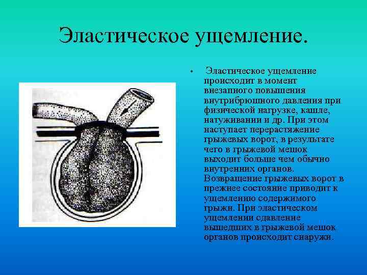 Эластическое ущемление. • Эластическое ущемление происходит в момент внезапного повышения внутрибрюшного давления при физической