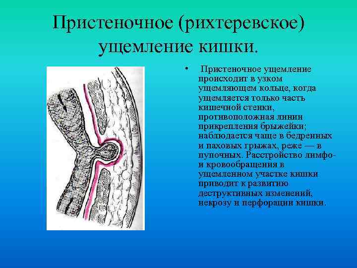 Пристеночное (рихтеревское) ущемление кишки. • Пристеночное ущемление происходит в узком ущемляющем кольце, когда ущемляется