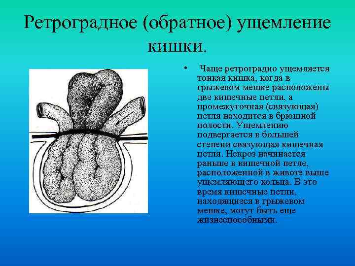 Ретроградное (обратное) ущемление кишки. • Чаще ретроградно ущемляется тонкая кишка, когда в грыжевом мешке