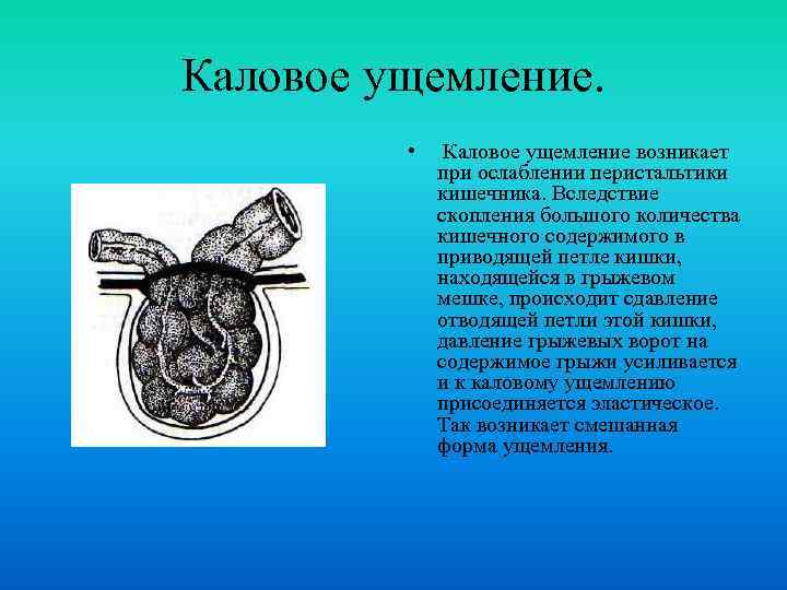 Каловое ущемление. • Каловое ущемление возникает при ослаблении перистальтики кишечника. Вследствие скопления большого количества