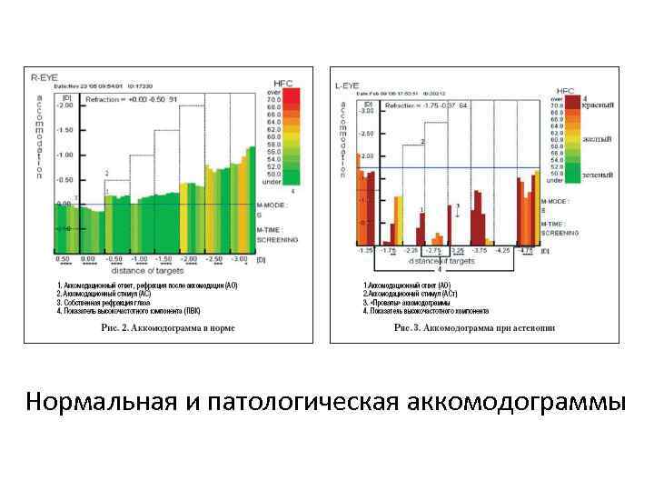 Нормальная и патологическая аккомодограммы 