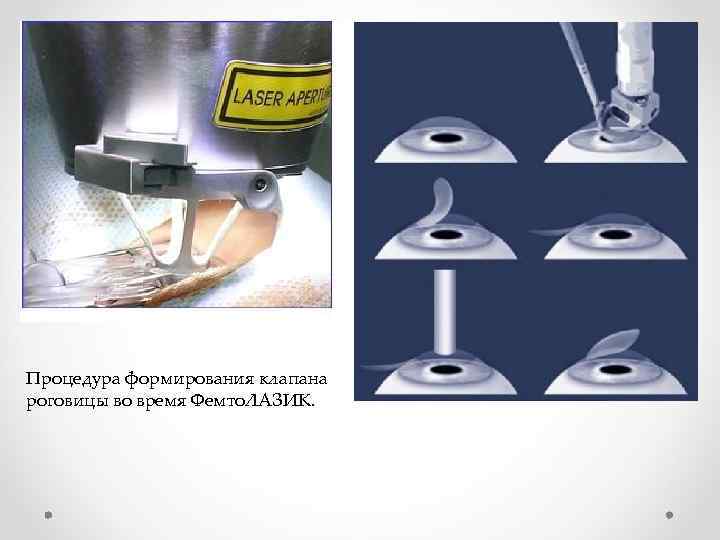 Процедура формирования клапана роговицы во время Фемто. ЛАЗИК. 