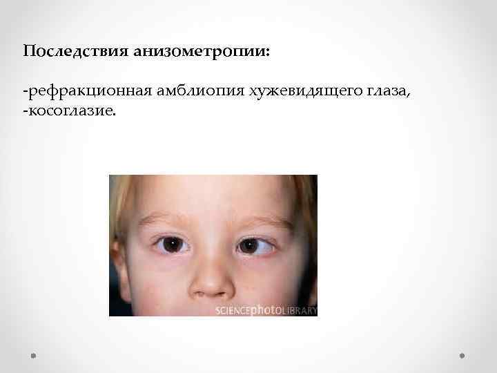 Последствия анизометропии: -рефракционная амблиопия хужевидящего глаза, -косоглазие. 