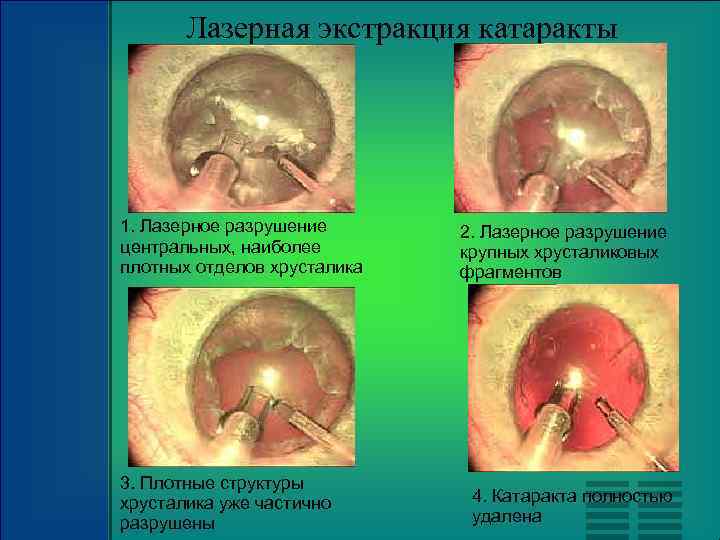 Лазерная экстракция катаракты 1. Лазерное разрушение центральных, наиболее плотных отделов хрусталика 3. Плотные структуры