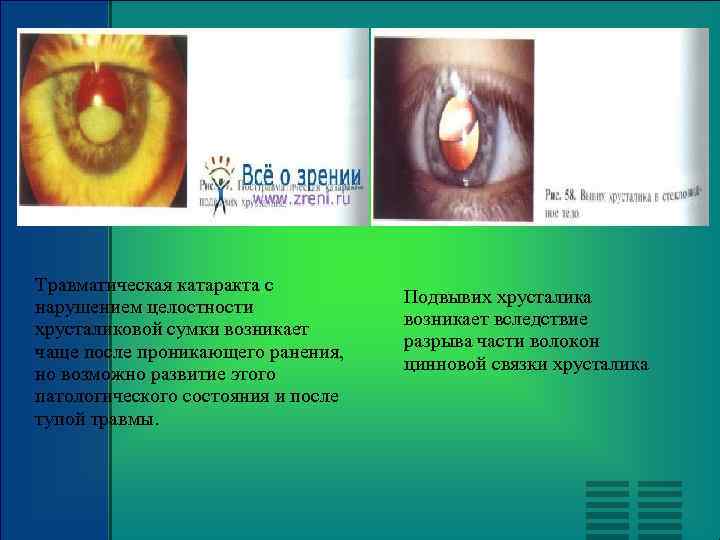 Травматическая катаракта с нарушением целостности хрусталиковой сумки возникает чаще после проникающего ранения, но возможно