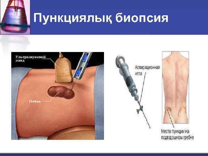 Пункциялық биопсия 