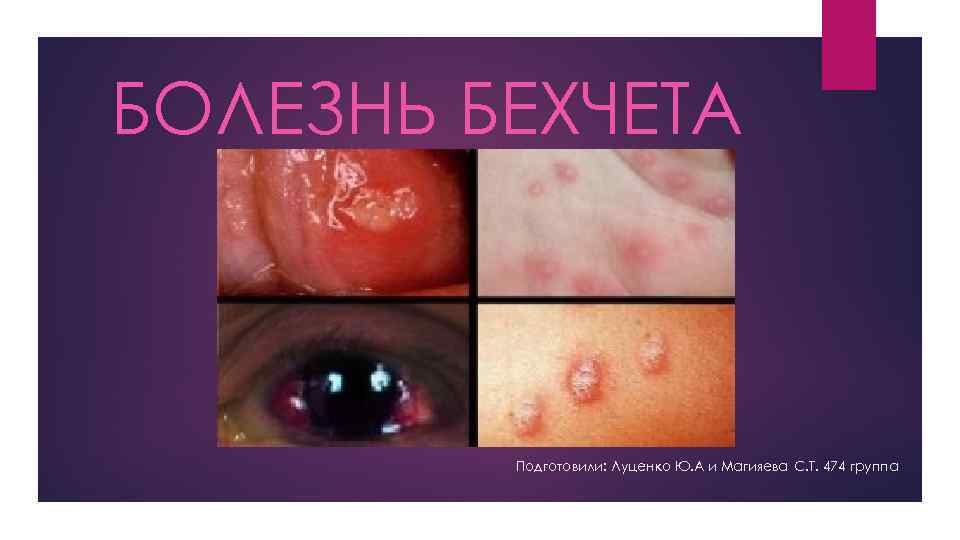 БОЛЕЗНЬ БЕХЧЕТА Подготовили: Луценко Ю. А и Магияева С. Т. 474 группа 