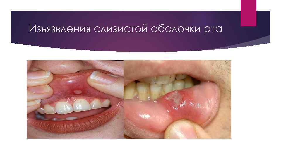 Изъязвления слизистой оболочки рта 