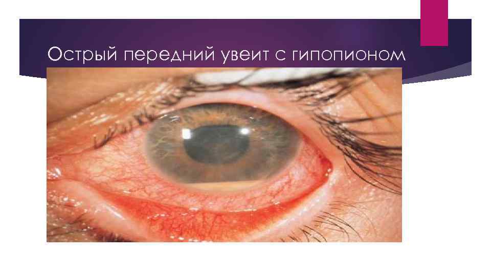 Острый передний увеит с гипопионом 