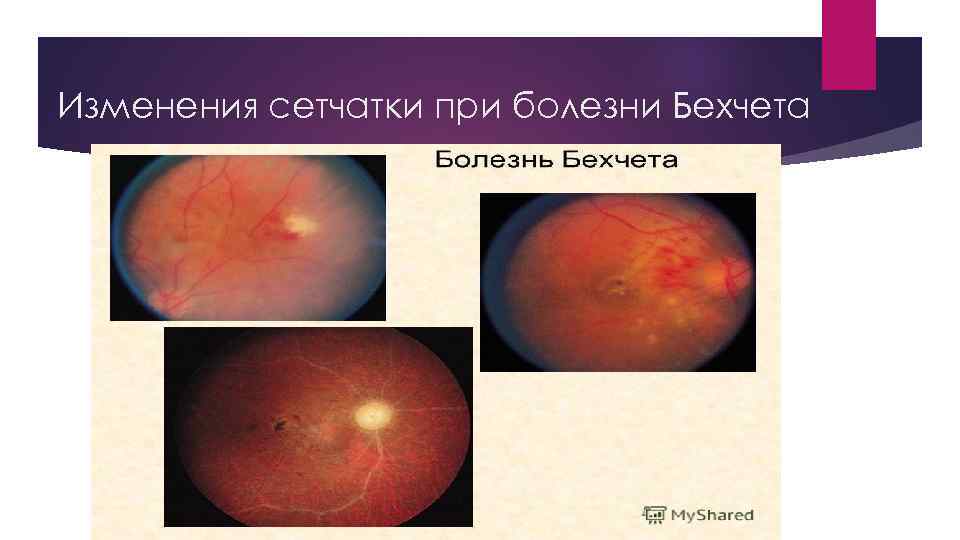Изменения сетчатки при болезни Бехчета 