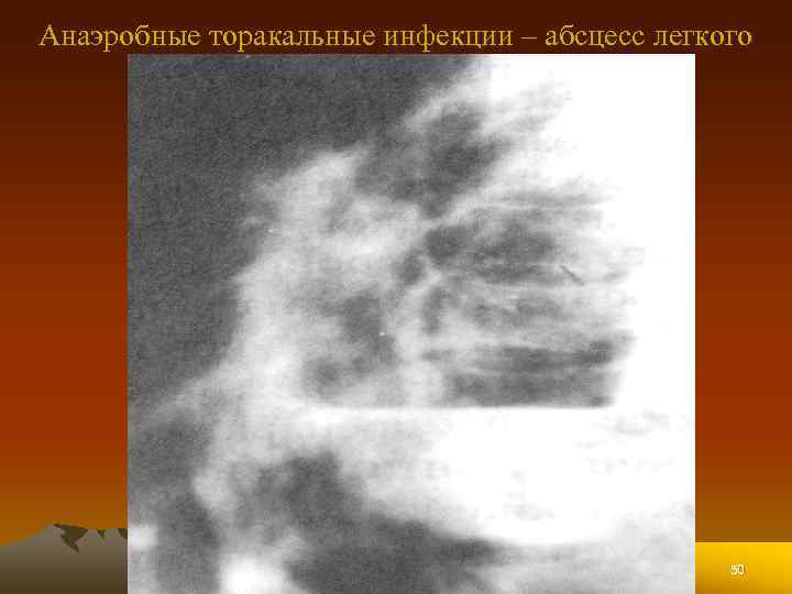 Анаэробные торакальные инфекции – абсцесс легкого 50 