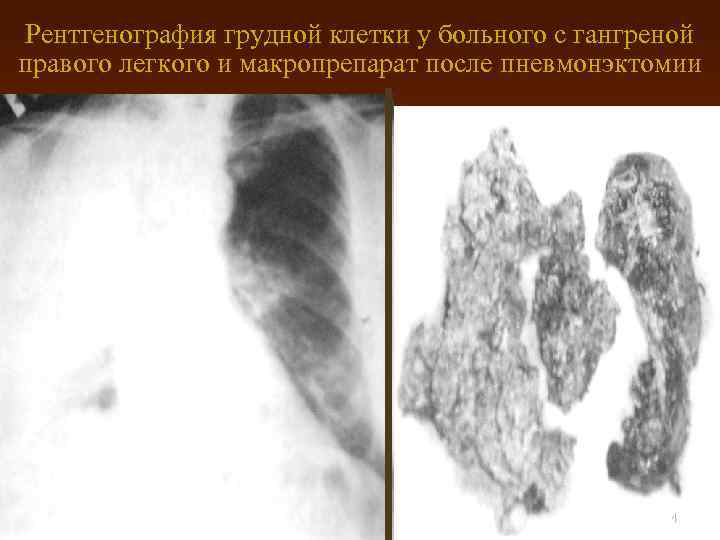 Рентгенография грудной клетки у больного с гангреной правого легкого и макропрепарат после пневмонэктомии 54