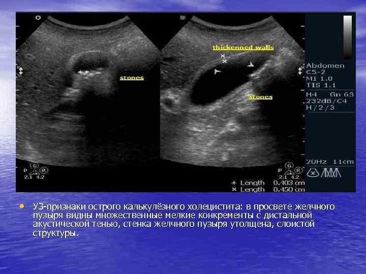  • УЗ-признаки острого калькулёзного холецистита: в просвете желчного пузыря видны множественные мелкие конкременты